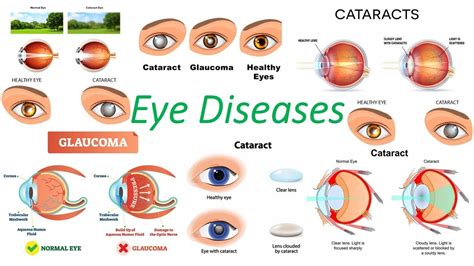 Diseases Of The Eye