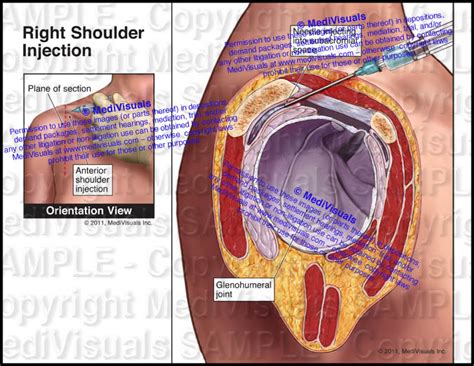 Right Shoulder Injection (Subacromial Bursa) - Medivisuals Inc.