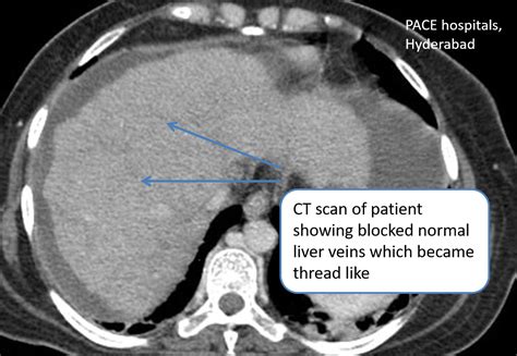 Budd-Chiari syndrome (Hepatic Vein Thrombosis) - DIPS procedure