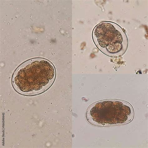 Three patterns of Hookworm eggs; the parasite in stool, under 40X light ...