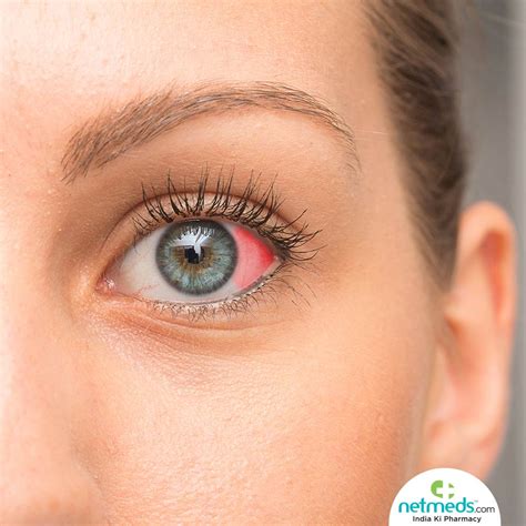 Red Spot On Eye: Causes, Symptoms And Treatment | Netmeds