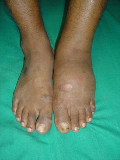 Charcot Foot: Causes, Picture, Symptoms And Treatment