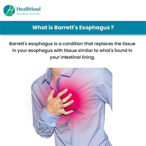 Barrett’s Esophagus: Causes, Symptoms and Treatment – Healthsoul