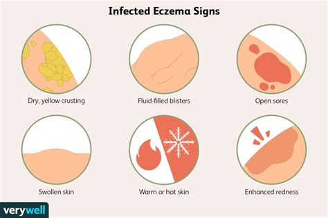 Infected Eczema: Symptoms, Pictures, and Treatment