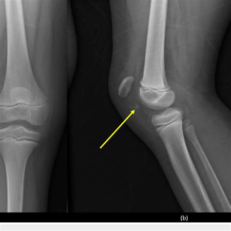 (PDF) Patellar Sleeve Fracture in an Eight-Year- Old Girl