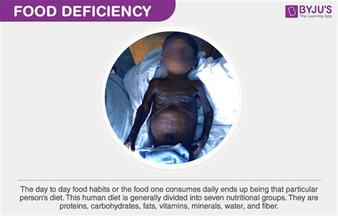 Food Deficiency- List of Nutrients, Sources and their Deficiencies