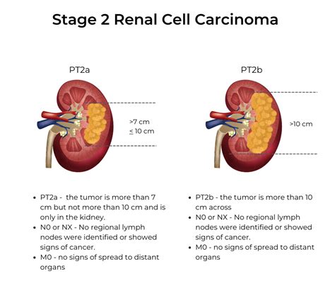 Kidney Cancer Stages | KCCure | kidney cancer | diagnosis | stages