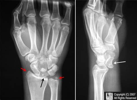 Learning Radiology - Lunate, Dislocation, Perilunate