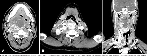 Figure 2 from Retropharyngeal Lymph Node Metastasis from Thyroid ...