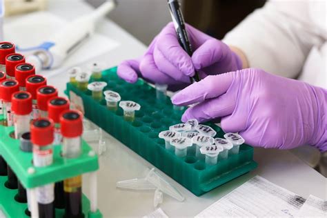 Understanding Your UE (Urea and Electrolytes) Blood Test Result - TheOS