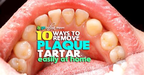 10 Easy Ways to Remove Plaque and Tartar from Teeth At Home Naturally ...