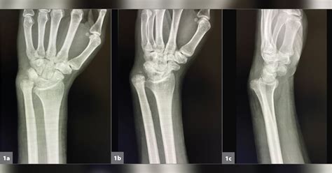 A 39-year-old man with a chronic Monteggia fracture-dislocation ...