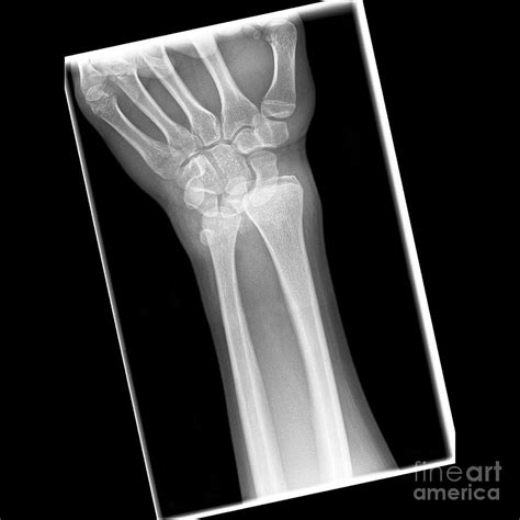 Dislocated Wrist, X-ray Photograph by Science Photo Library