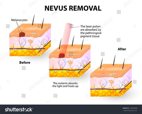 Nevus Removal Stock Photo 176634008 : Shutterstock