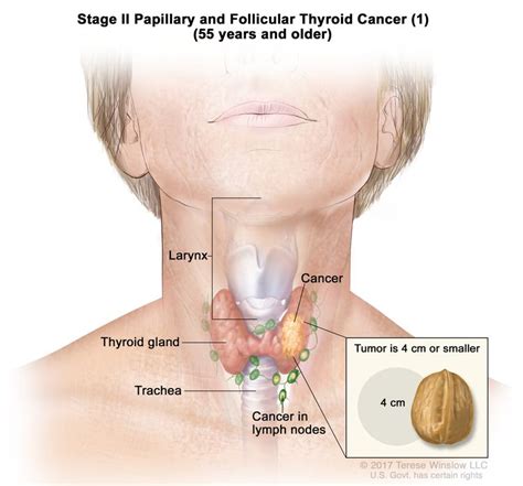 Thyroid Cancer Treatment (PDQ®)–Patient Version - NCI