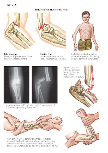 Holstein Lewis Fracture Treatment | ReviewLeading