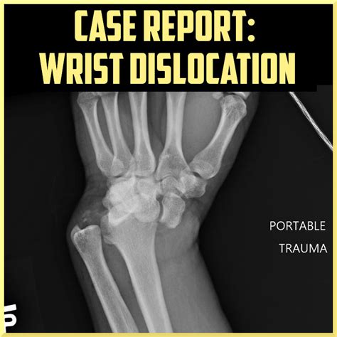 Wrist Dislocation After Motorcycle Crash - Sports Medicine Review