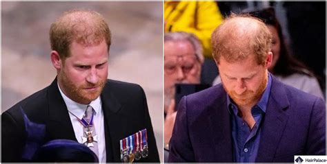 Prince Harry Hair Transplant | A Royal Makeover