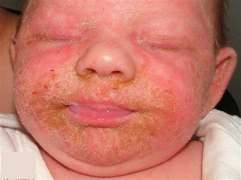 Infantile seborrheic dermatitis, causes, symptoms, diagnosis & treatment