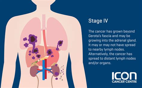 Kidney Cancer — Icon Cancer Centre Singapore