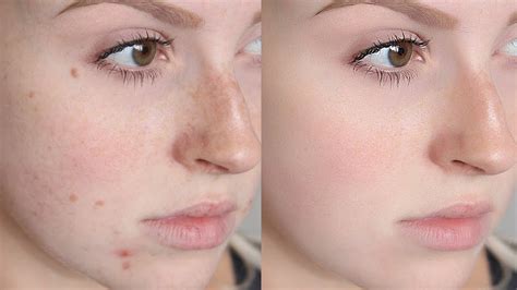 How To Remove Acne & Make Smooth Skin Using Portraiture In Photoshop CC ...