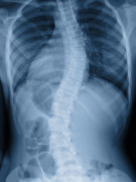 Scoliosis | MedlinePlus