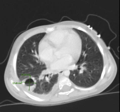 CT scan of the chest: abscess formation in the right lower lobe ...