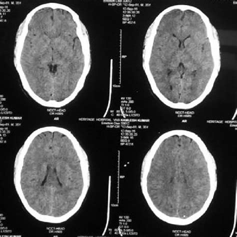 Computed tomography of the head revealed calcified granuloma in the ...