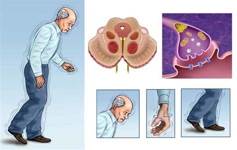 Parkinson's disease signs and causes, symptoms, treatment - Page 2 of 8