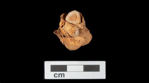 Tumor With Teeth Found In The Body Of A 3,000-Year-Old Egyptian Woman