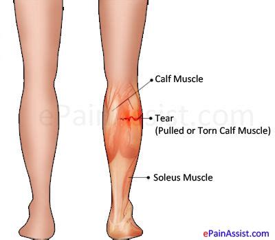 Exercises For Torn Calf Muscles - Dumbbell Shub