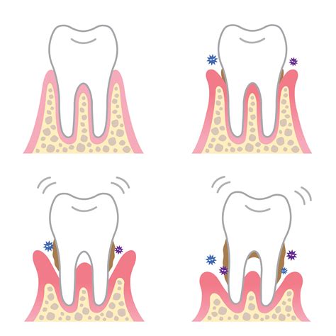 What is Flap Surgery and Bone Grafting? — Peak Dental - Logo