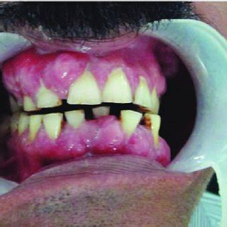 (PDF) Amlodipine Induced Gingival Hyperplasia – a Case Report and Review