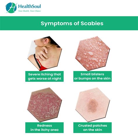 What Are Scabies Rash Treatment Symptoms Pictures Healhty And Tips ...