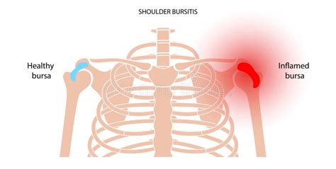 Bursitis is the Inflammation of Bursae Stock Vector - Illustration of ...