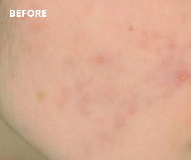 Acne Laser Genesis | Acne Scars Removal Vancouver | NuAGE Laser