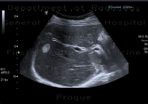 Radiology case: Liver hemangioma