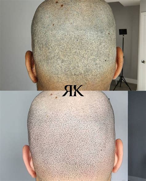 Scar Camouflage | Scalp Micropigmentation | Ryan Kingsbury