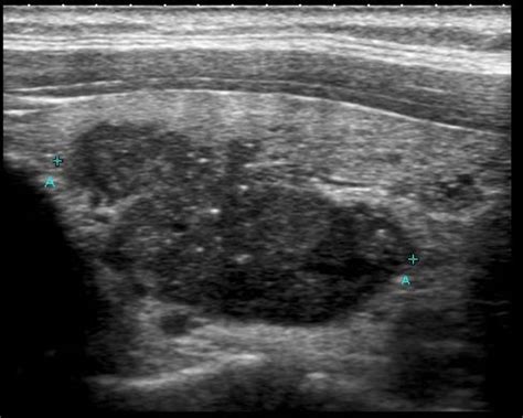 Papillary thyroid cancer echocardiography or ultrasound - wikidoc