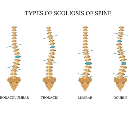 Lumbar Scoliosis Exercises