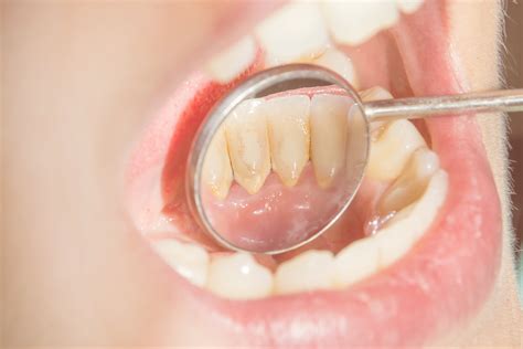 Dental Tartar (Calculus) - Causes, Prevention and Removal