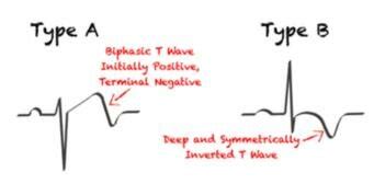 Two patterns of Wellens Syndrome [] | Download Scientific Diagram