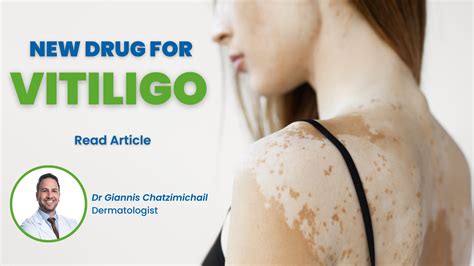 Vitiligo New Treatment 2024 Nj - Adora Ardelia