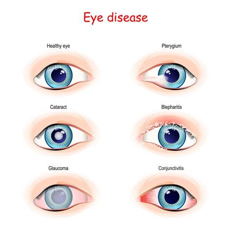 Pinguecula and Pterygium - Henderson Eye Care