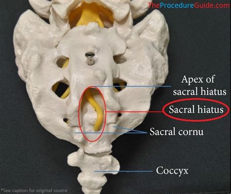 Fluoroscopic Guided Caudal Epidural Steroid Injection – Technique and ...