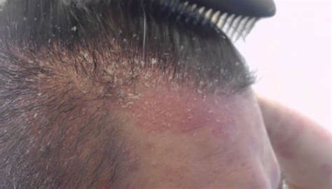 How to Treat Psoriasis and Dry Scalp with Shampoo – Paul M. Barrett