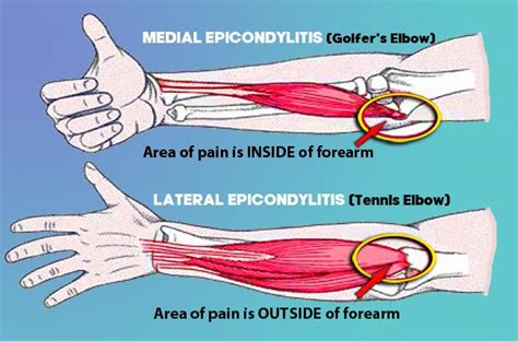 Lateral And Medial Epicondylitis