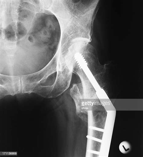 Hip Fracture X Ray Photos and Premium High Res Pictures - Getty Images