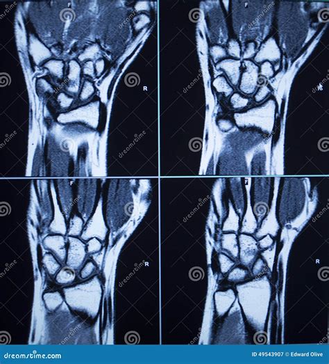 MRI Scan Test Results Wrist Hand Injury Stock Image - Image of medical ...