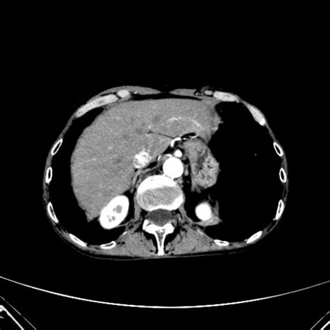 ct scan emphysema - democratiz3D® Processing - embodi3D.com